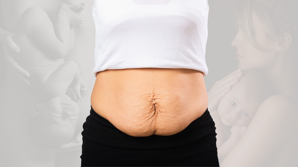 Postpartum / After delivery-Abdominal separation / Diastasis recti medical compression